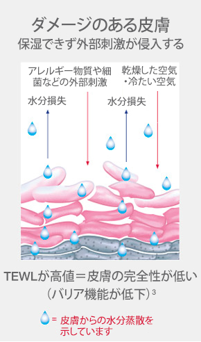 illustration-of-unhealthy-skin-layers-caused-by-water-loss